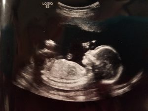 20 week ultrasound profile